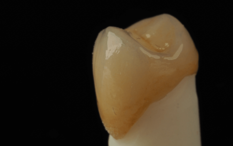 korona cyrkonowa licowana porcelana
