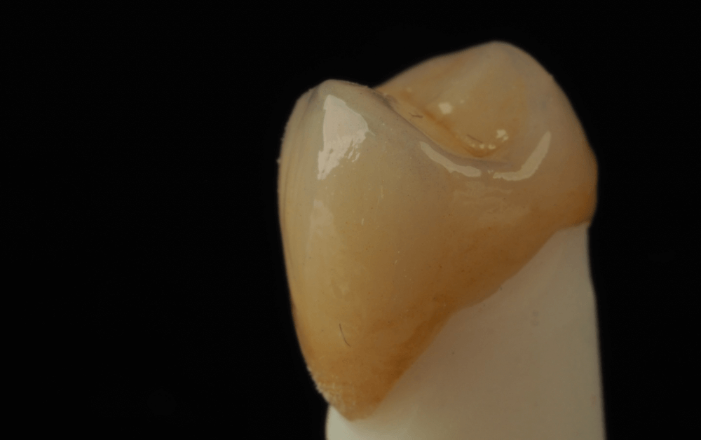 korona cyrkonowa licowana porcelana