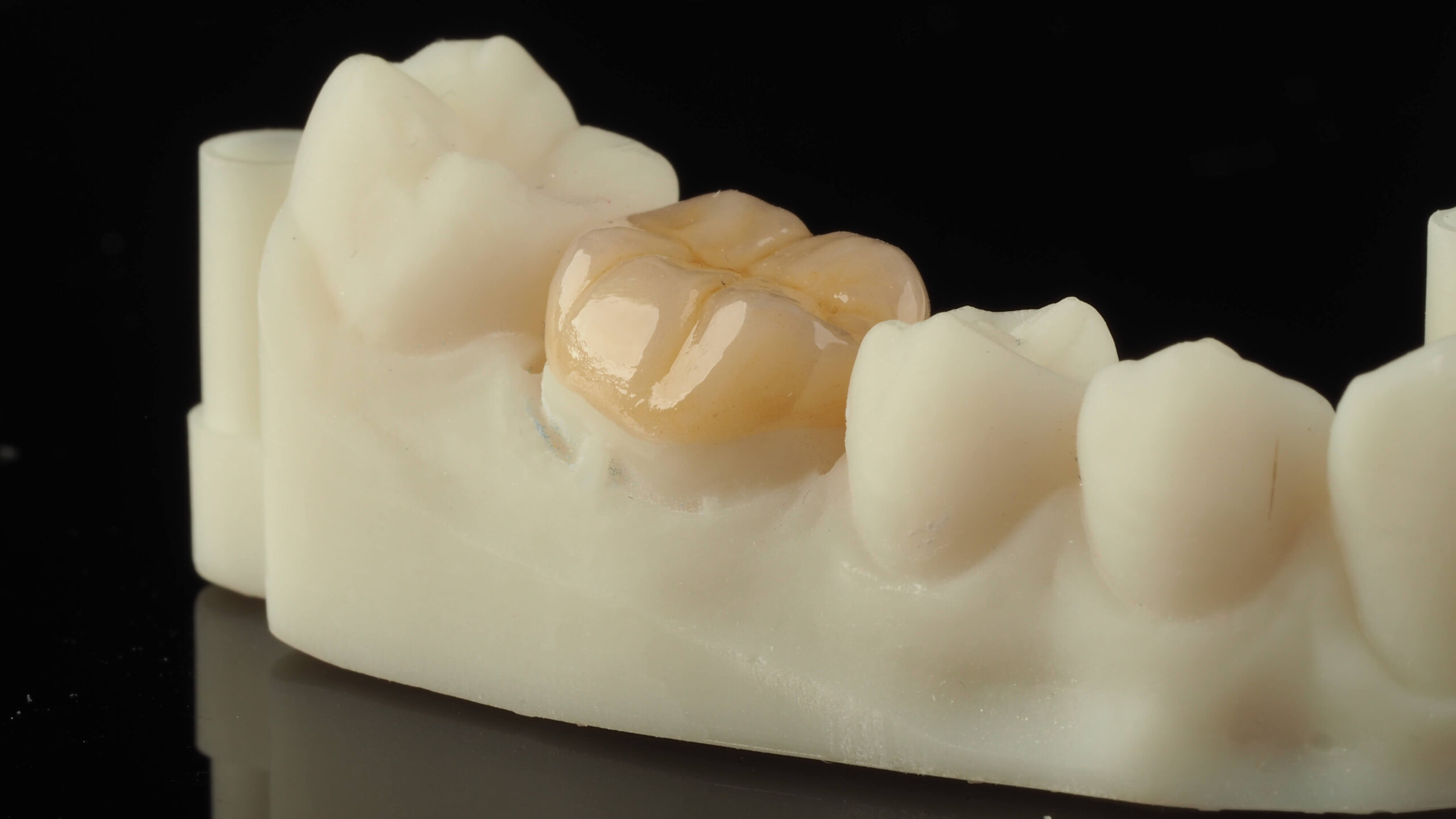 overlay ceramiczny