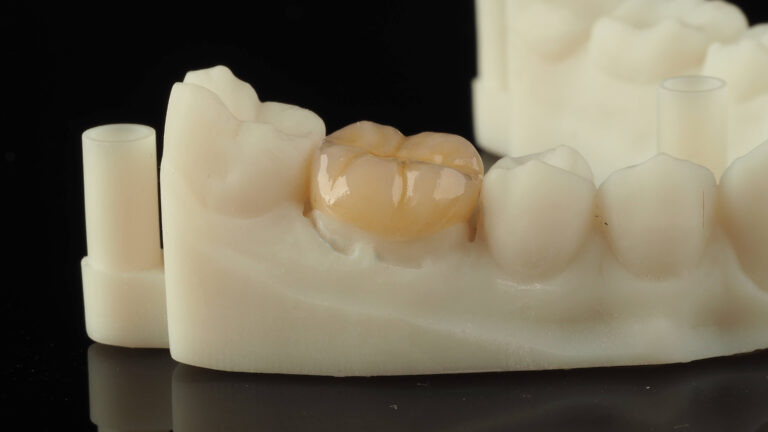 inlay exacto lab