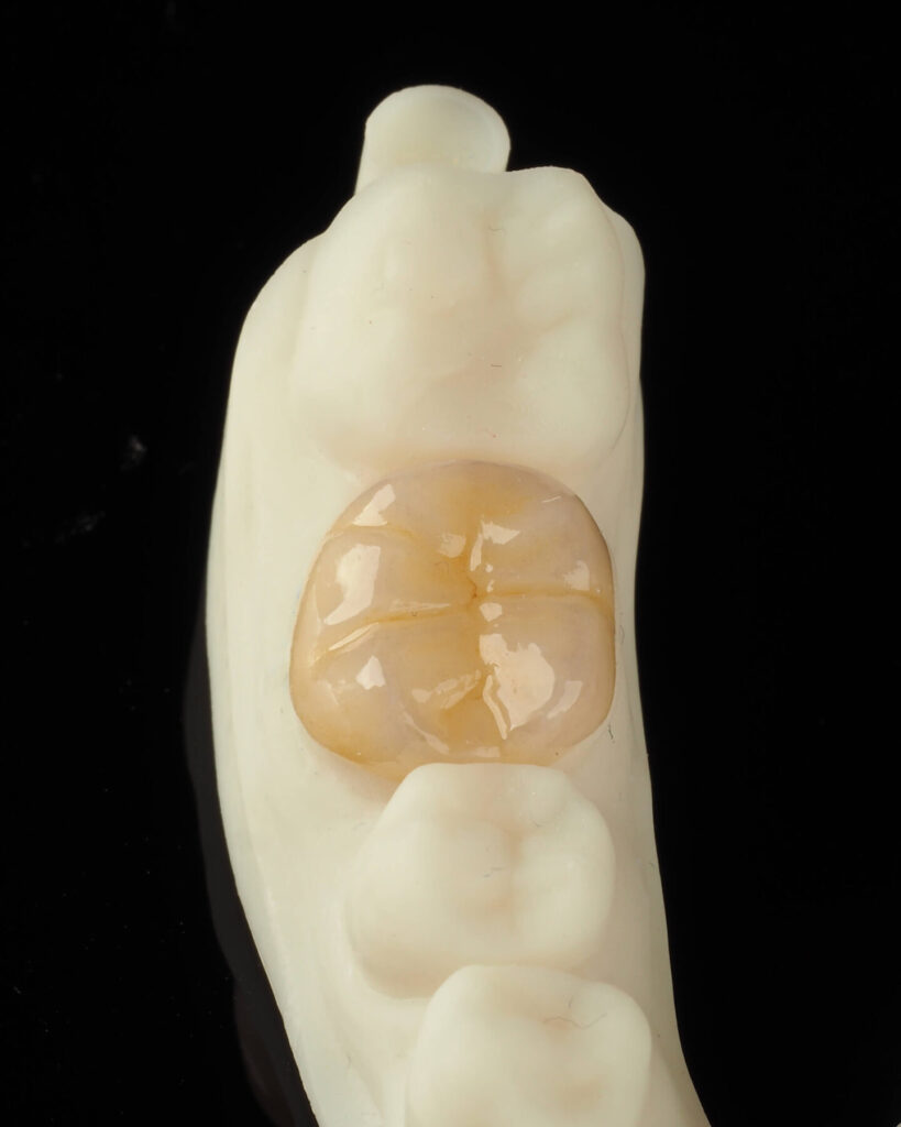 naklad ceramiczny overlay