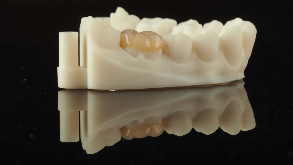 krona cyrkonowa licowana exacto lab