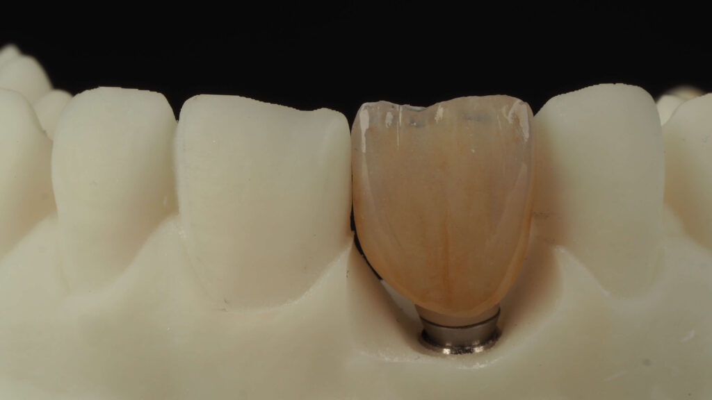 korona przykręcana na bazie tytanowej