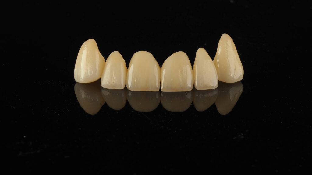 Licówki bez szlifowania poznań