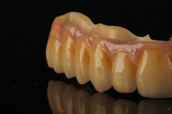 proteza na dwóch implantach overdenture to tańsze rozwiązanie, dla pacjentów ze średnim zanikiem kostnym